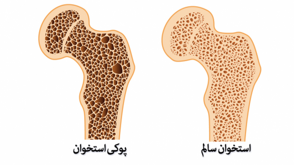 آیا در سنین بالا هم می‌توان تراکم استخوان را افزایش داد؟